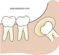 What is the most common location for a dentigerous cyst?