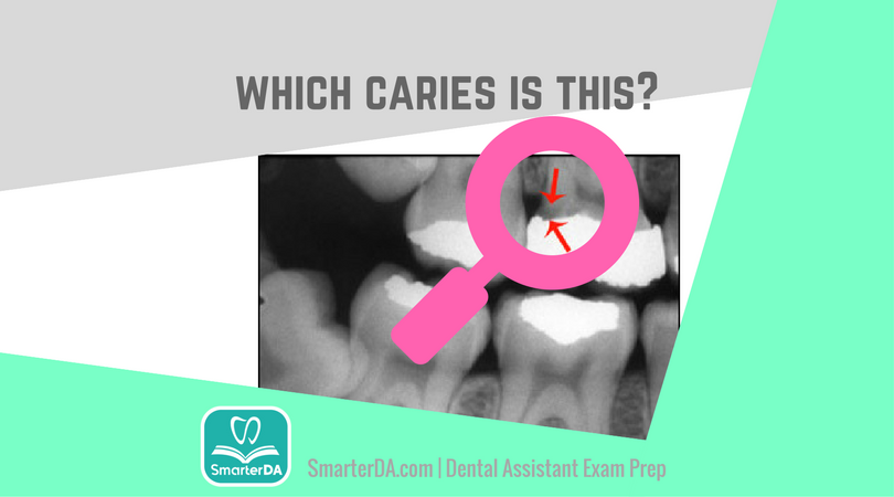 Q: The image highlights which type of caries?