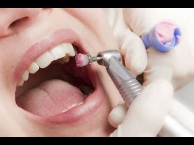 Indications and Contraindications for Coronal Polishing [Dental Hygiene]