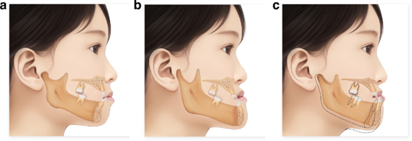 What Your Bite Says About Your Health: Understanding Malocclusion
