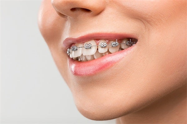 Why Metal Braces Still Reign Supreme in Modern Orthodontics